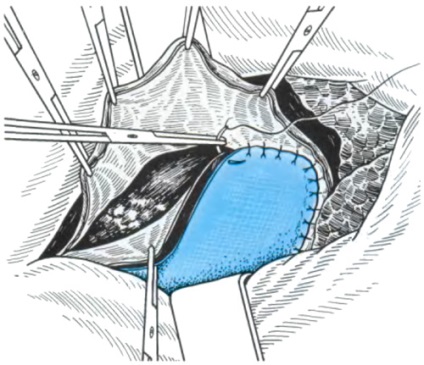 Allsurgery - грижі власне діафрагми