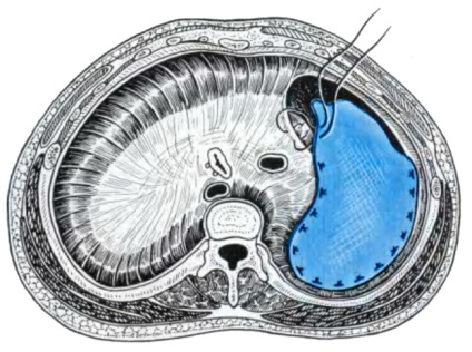 Allsurgery - diafragma hernia adecvata