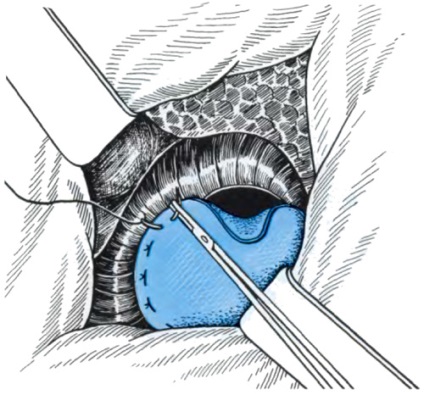 Allsurgery - diafragma hernia adecvata