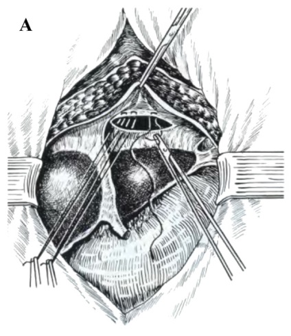 Allsurgery - diafragma hernia adecvata