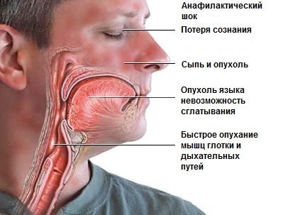 Sindromul anafilactic provoacă șocuri, simptome, tratament