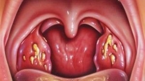 Angina (akut tonsillitis) kezelés, orvosi portál