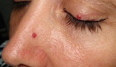 Angioma - tipuri, cauze, simptome, tratament