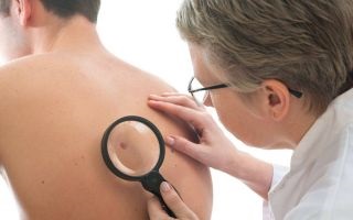 Carcinomul bazocelular al pielii cauzează, simptome și tratament