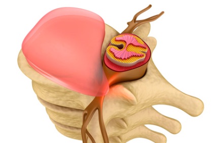 Sarcina și hernia coloanei vertebrale lombare pot da naștere
