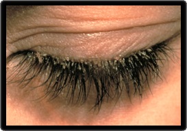 Blefarita - simptome și tratament, fotografii ale ochilor, ochilor și vederii