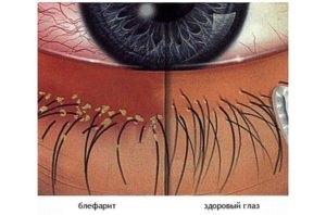 Blefarita - simptome și tratament, fotografii ale ochilor, ochilor și vederii