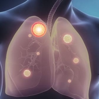 Bronșita - tratamentul remediilor populare la domiciliu