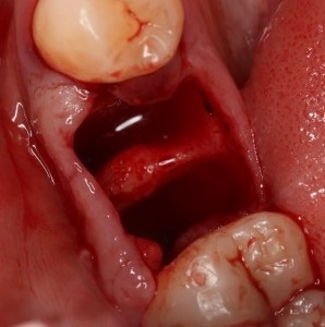 Ce se poate face daca dupa o extragere dinte sangele nu se opreste