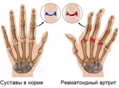 Ceea ce este util pentru articulații este o listă de alimente care sunt obligatorii în dietă