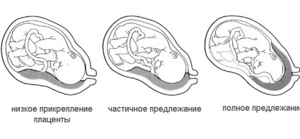 Ce este placenta previa și ce să faceți cu această patologie