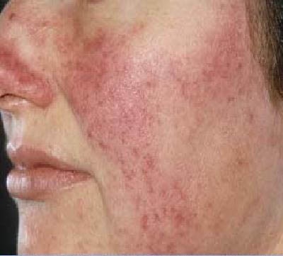 Ce este rosacea