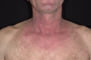 Dermatitis-fotó tünetek és kezelés felnőttekben