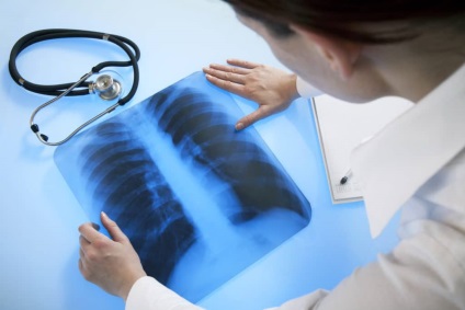Diagnosticarea cu raze X a cancerului pulmonar în diferite stadii