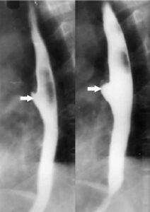 Diverticulul esofagian cauzează, simptome, tratament, gastrolife