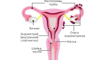 Fizioterapie pentru endometrioză, electroforeză, magnetoterapie și alte variante de fizioterapie