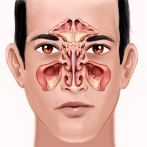 Inhalarea cu instrucțiuni sinupretom, aplicarea într-un nebulizator pentru un copil, contraindicații