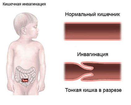 Invaginarea simptomelor intestinale, tratamentul, prevenirea, cauzele bolii