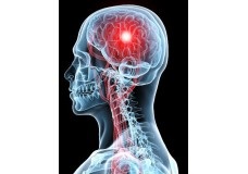 Factorul ischemic de accident vascular cerebral și factorul de transfer al tratamentului
