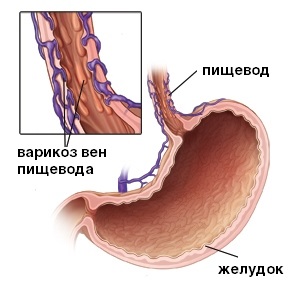 Hogyan nyissa meg fájdalmasan az ereket