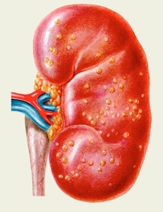 Mit kell tennie az antibiotikumokkal pyelonephritis - kinevezési szabályok, empirikus kezelés