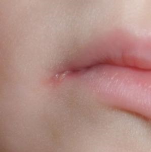 Cum să tratați mirosurile în colțurile gurii