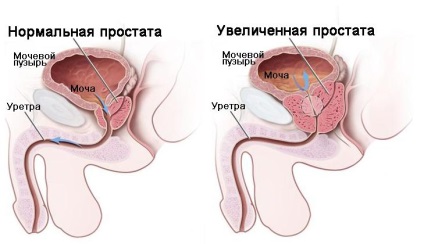 Cum de a identifica cancerul de prostată prin simptome, cărți