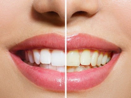 Cum să vă albiți dinții acasă fără a dăuna smalțului și gingiilor, frumos