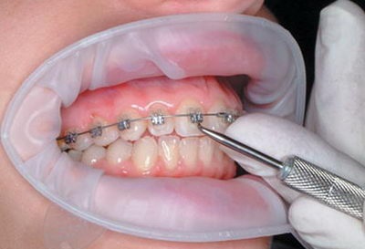 Cum se elimină bretelele din dinți descrierea procedurii, prețurile