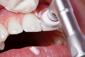Cum se elimină bretelele din dinți descrierea procedurii, prețurile