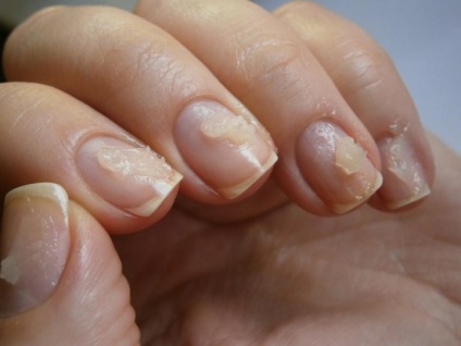 Cum să restabilească sănătatea la unghiile după îndepărtarea șelacului