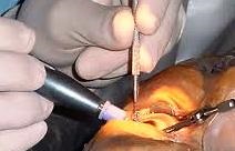 Cataractă - tratamentul cataractei