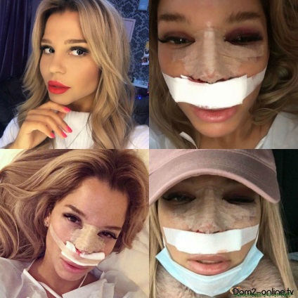 Katya Kalishnichenko did rhinoplasty, fotó műtét után