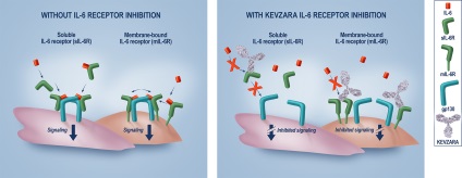 Kevzar »egy új gyógyszer a rheumatoid arthritis, gyógyszerek kezelésére