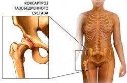 Coxarthrosis - a csípőízület deformáló artrózisa