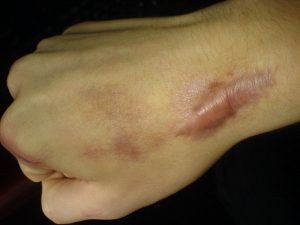 Cicloide cicatrice - tratament cu remedii folclorice de cicatrici proaspete