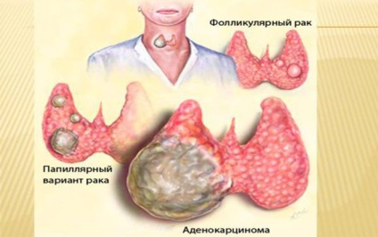 Cum și dureri în gât cu simptome ale glandei tiroide