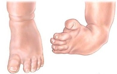 Clubfoot congenital