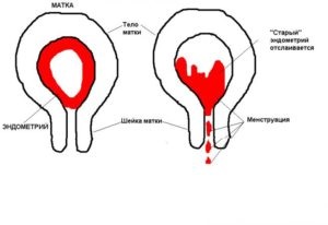 Sângerarea în timpul hiperplaziei și tratamentului endometrial