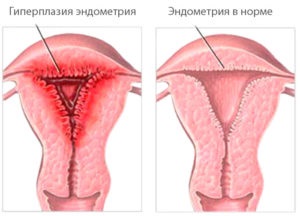 Sângerarea în timpul hiperplaziei și tratamentului endometrial