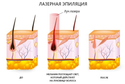 Epilare cu sprâncene cu laser, deoarece există o înlăturare a sprâncenelor pentru totdeauna