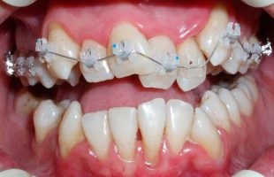 Tratamentul bolii parodontale la domiciliu și caracteristicile terapiei populare