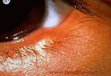 Tratam ochii de orz cu căldură uscată (sănătate feminină)