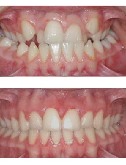 A nyelvi braces árak, a felnőttek és gyermekek láthatatlan melltartóinak felszerelésének költsége, a rendszer