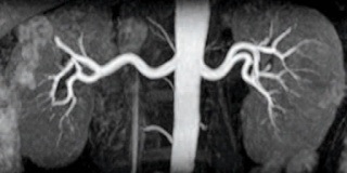 Analiza angiografiei prin rezonanță magnetică a arterelor renale - prețuri, rate, decodificare, pregătire,