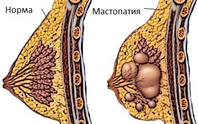 Mastopatia - cum este tratamentul pentru mastopatie