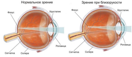 Micopia miopiei oculare de grad scăzut, grad ridicat de miopie, miopie medie a ochiului, semne și