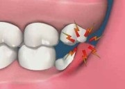 Monopakuláris fogkefe funkciók, kiválasztási szabályok, modellek áttekintése