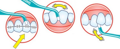 Egy fogú fogkefe - a szájhigiénia tökéletes megközelítése - az okklúzió kijavítása és