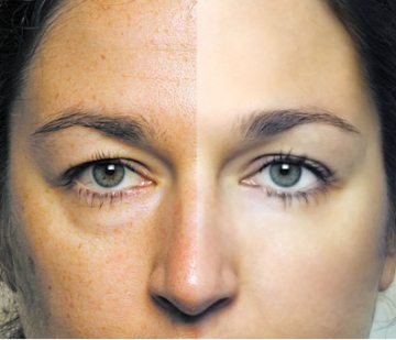 Remedii populare pentru pigmentare pe fața celor mai bune rețete